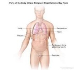 Malignant Mesothelioma Market Growth Outlook And Forecast 2023-2032